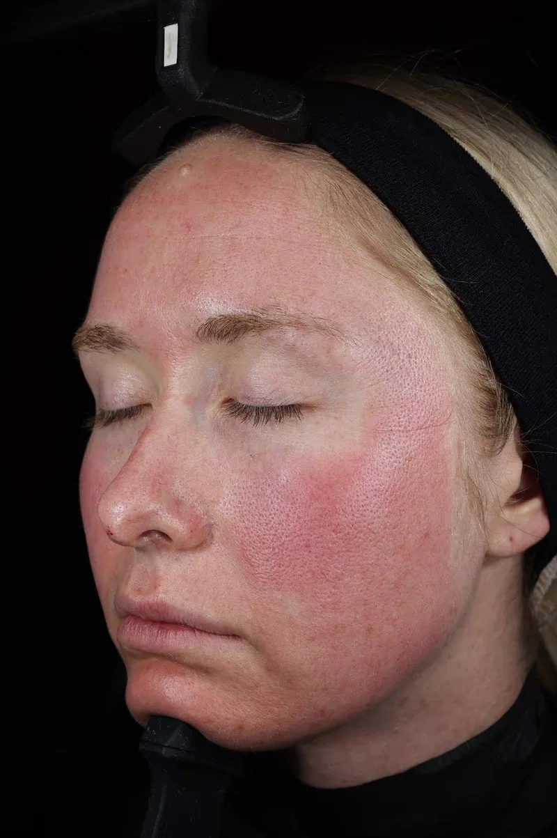 Peau quatre heures après la séance SkinPen