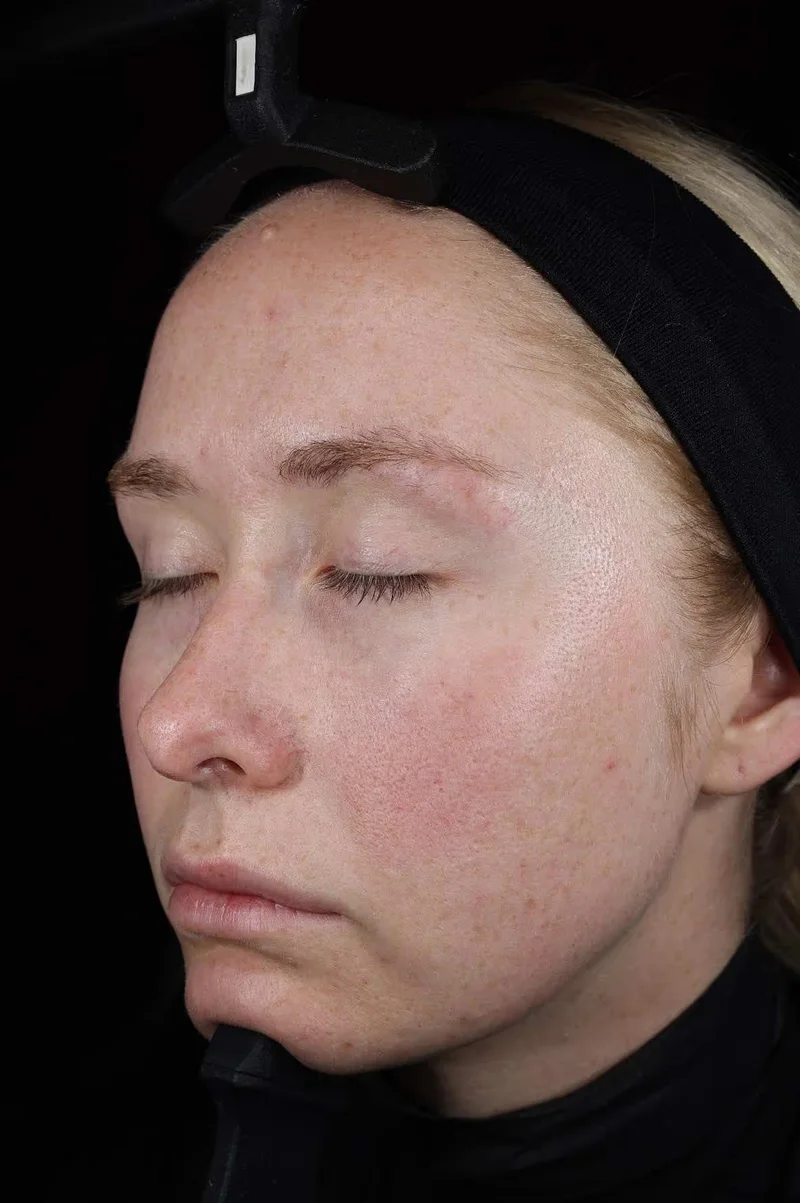 Peau avant la séance SkinPen